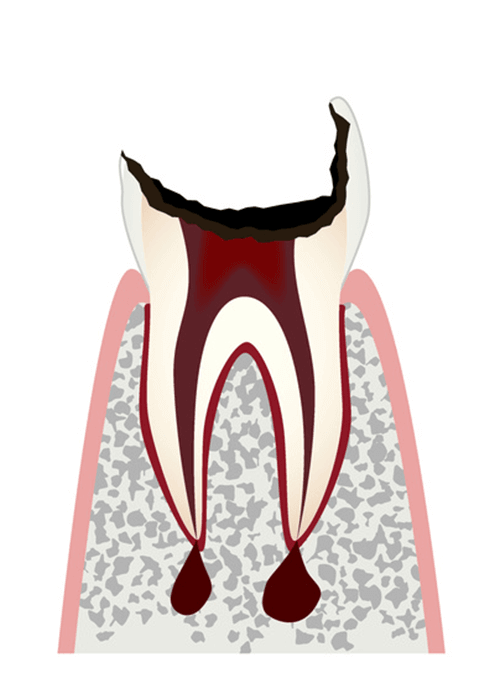 歯質が大きく失われた歯